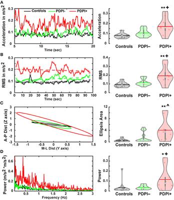 Cortical and Cerebellar Oscillatory Responses to Postural Instability in Parkinson's Disease